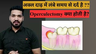 अक्ल दाढ़ का दर्द है  Operculectomy [upl. by Manus]