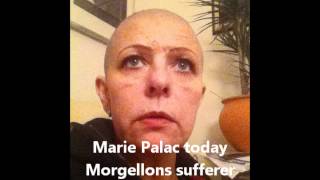 Morgellons Disease The Big Lie The Ultimate Coverup [upl. by Retloc]