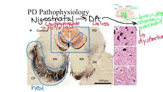 Parkinsons Disease Pathophysiology [upl. by Ahserb]