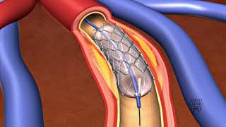 Animation  Coronary stent placement [upl. by Ji]