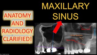 ALL Maxillary Sinus Anatomy 3D CBCT Mucosal Thickening in x ray OPG easy maxillary sinusitis lecture [upl. by Treacy]