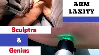 Treating Arm Laxity with Sculptra amp Genius [upl. by Alaunnoif933]