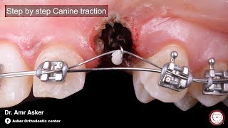 Step by step surgical exposure and orthodontic traction of impacted canine by Amr Asker [upl. by Anniken363]