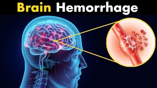 What Happens in Brain hemorrhage  Symptoms Causes and Treatment 3d animation [upl. by Bork]