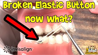 Invisalign Help  Broken Elastic Hook or Button and still want to wear your elastics  Dr Paulson [upl. by Rennoc]