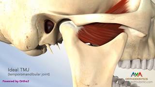 TMJ Disorder or TMD  Clicking and Closed Lock [upl. by Garbers360]