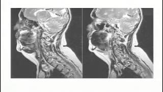 CranioCervical Syndrome CCS Symposium  April 6 2013 Raymond V Damadian MD [upl. by Eirelav]