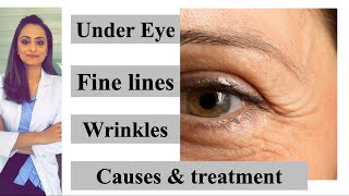 Fine lines  wrinkles under eye causes amp treatment Prevention  Dr Aanchal Panth [upl. by Ykcim963]