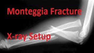 Monteggia Fracture Xray Setup [upl. by Royden849]