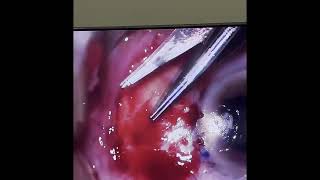 Pterygium Surgery [upl. by Etnaed91]