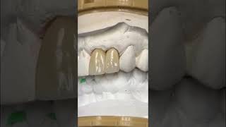 Central and Lateral Crowns lsk121shorts dentist teethsmile [upl. by Capps]