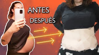 💥​EMBARAZO después de una ABDOMINOPLASTIA💥​ QUE ES LA ABDOMINOPLASTIA [upl. by Chloras]