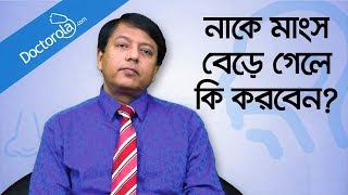 Hypertrophy nasal turbinates  নাকের মাংস বৃদ্ধি  নাকের মাংস বাড়লে করণীয়  Blocked nose relief [upl. by Neelhtak941]