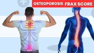 How to Detect Osteoporosis osteoporosis [upl. by Nataniel]