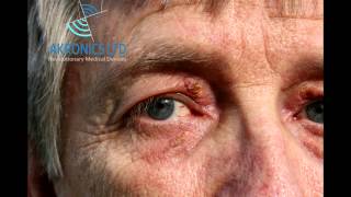 Xanthelasma Removal without TCA [upl. by Briney]