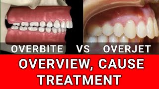 Overbite VS Overjet  Condition Overview Cause and Treatment [upl. by Bent]