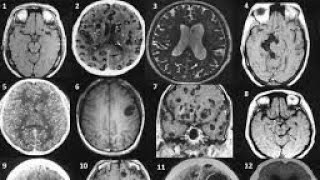 BRAIN NCC NEURO CYSTIC CERCOSIS [upl. by Onaicul668]