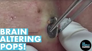 The POPS That Altered My Brain Chemistry 20 Minutes Dr Pimple Popper Best Of [upl. by Annaik376]