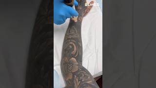 How to remove a Permanent Tattoo Laser vs Tattoo ☠️ [upl. by Eybba]