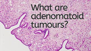 What are Adenomatoid Tumours  Pathology mini tutorial [upl. by Lesser361]