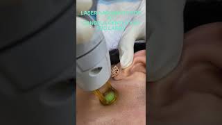 Candela Gentle YAG Pro Laser Treatment for Unwanted Hair Reduction shortsfeed shorts [upl. by Leonardi]