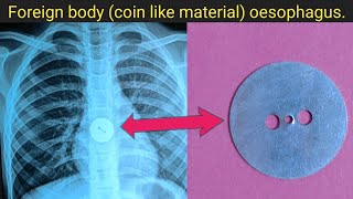 Foreign body coin like material oesophagus  EndoCut [upl. by Stiegler]