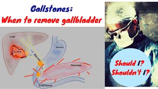 Gallstones when to remove the gallbladder [upl. by Elroy]