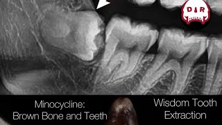 Minocycline Tooth Wisdom Tooth and Bone Stained with Tetracycline Wisdom Tooth Extraction Surgery [upl. by Alset252]