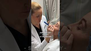 Cameron’s lip lift results will blow you away [upl. by Spring]