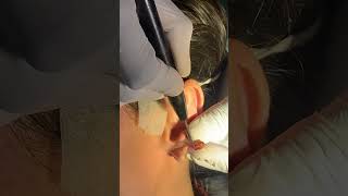 Earlobe Repair Treatment  Ear Lobe Pasting Kaise Kare  Earlobe Treatment  Skinaa Clinic shorts [upl. by Niuqram506]