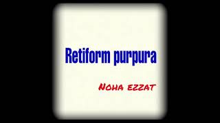 Retiform Purpura [upl. by Nelg]