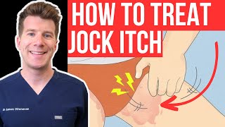 Doctor explains how to RECOGNISE AND TREAT JOCK ITCH aka Tinea Cruris or Ringworm of the groin [upl. by Howard]