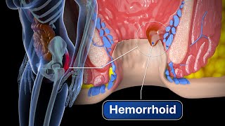 Hemorrhoid Removal  Step by step [upl. by Gae]