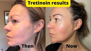 Dermatica tretinoin 6month results update  plus how to manage sun sensitivity [upl. by Nylirrej]