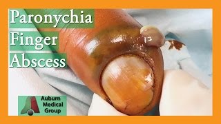 Paronychia Fingernail Abscess Infection Treatment  Auburn Medical Group [upl. by Emiatej539]