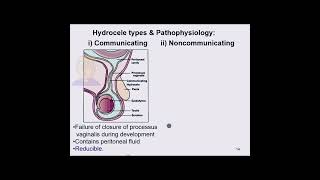 Communicating vs Noncommunicating hydrocele [upl. by Calandria]