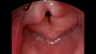 Laryngobronchoscopy  Laryngomalacia in a newborn baby [upl. by Noiraa]