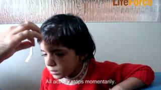 Video of Child with Petit Mal Epilepsy Attack Induced by Exertion Physical Effort [upl. by Nabois]