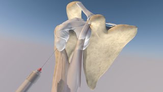 Anatomic Model of a Bicipital Sheath Injection by probeultrasound [upl. by Erline]