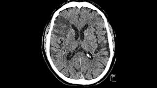 PROGRESS of a BRAIN INFARCT Day 1 Day 3 and 2 Weeks after CT findings [upl. by Bergmans]