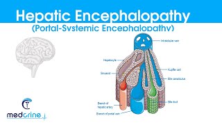 Hepatic Encephalopathy portal systemic encephalopathy causes classification featuresDX and rx [upl. by Lin501]