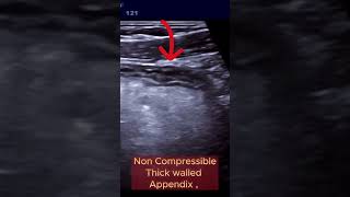 When Appendix becomes Infected and Complicated ultrasound appendicitis intestine [upl. by Ahcila]