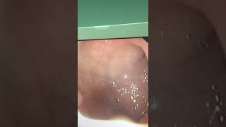 Upper endoscopy of a child with persistent vomiting one year ago showing gastritis and duodenitis [upl. by Husch696]