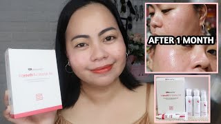 AFTER 1 MONTH USING RYX beyouthiful STARTER KIT  ACNE PRONE SKIN with BEFORE and AFTER [upl. by Naraj]