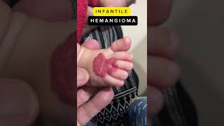 Infantile Hemangioma hemangioma infants treatment [upl. by Stinky]