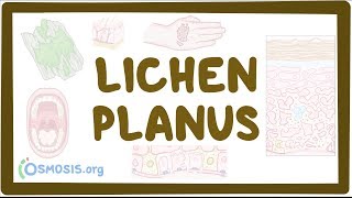 Lichen planus  causes symptoms diagnosis treatment pathology [upl. by Nahgen870]