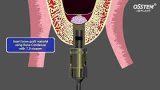 Internal Sinus Lift [upl. by Akoyin]