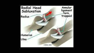 Radial Head Subluxation of RadiusDr Gohar Shahroz shortsfeed short doctor [upl. by Alenairam]