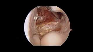 Elbow Arthroscopy  Tennis Elbow  Nicky Leung MD [upl. by Wyon]