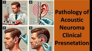 3 Pathology of Acoustic Neuroma Clinical Presnetation [upl. by Ebony]